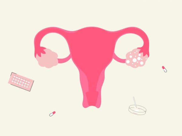 Understanding PCOS: Causes, Symptoms, and Treatment Options